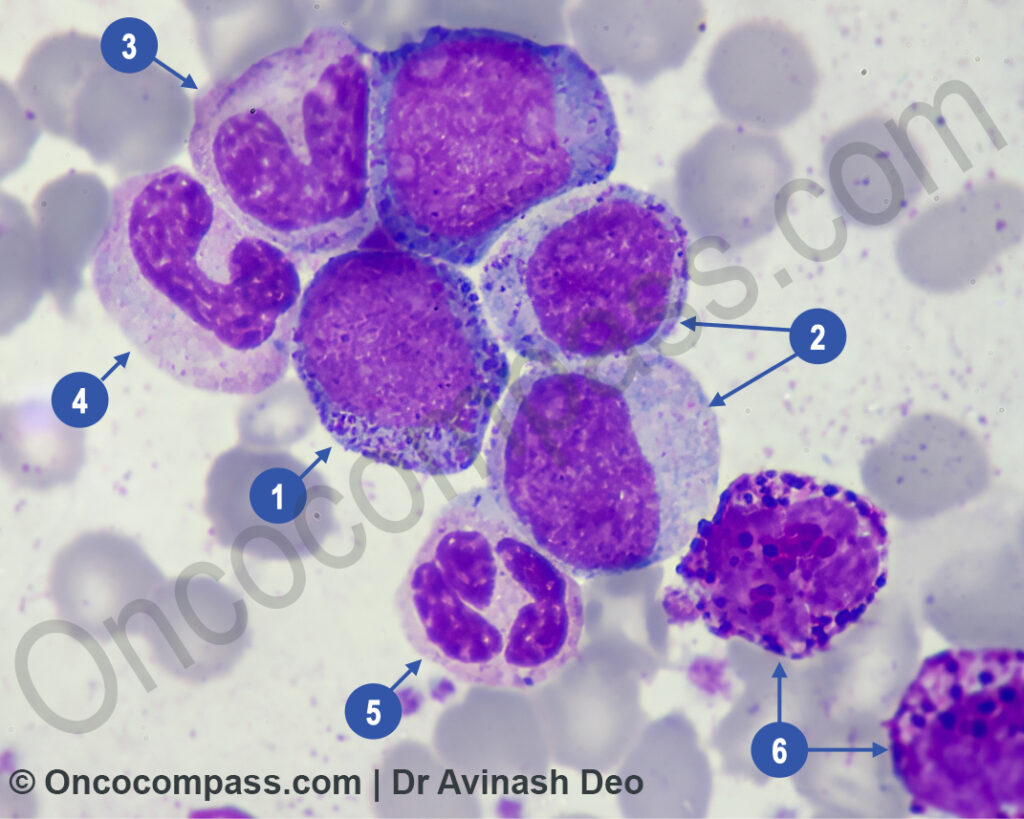 Chronic Myeloid Leumkemia (CML) peripheral Smear